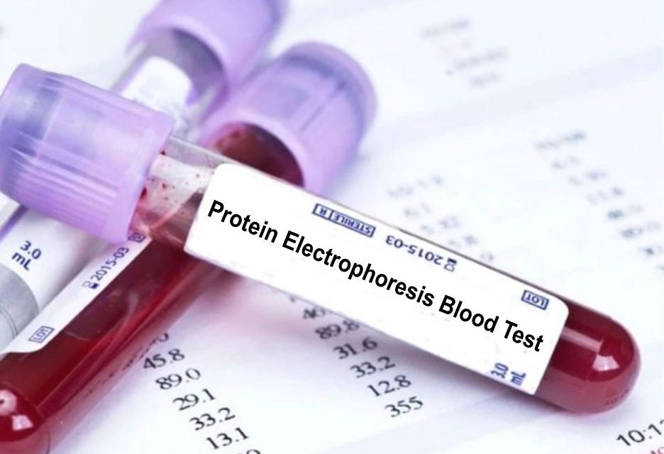 Protein Electrophoresis – What and Why Do I Need this Blood Test?